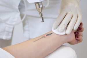 Laser Tattoo Removal in Bowie, MD