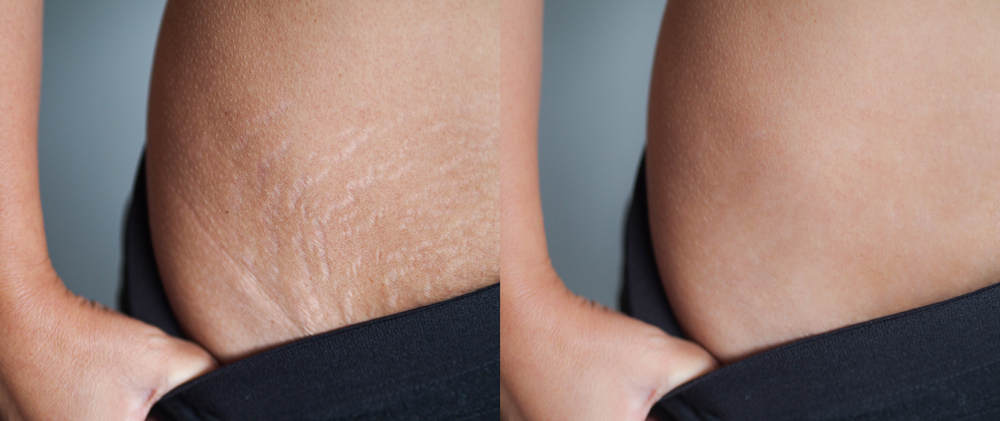 Morpheus8 for Stretch Marks: Addressing Skin Imperfections Safely | RoseHall Medical Aesthetics