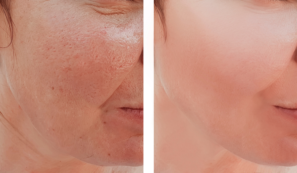 The Healing Process Recovering From Skin Resurfacing Procedures | RoseHall Medical Aesthetics