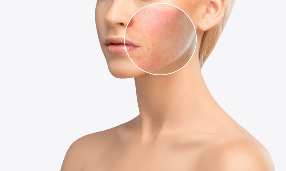 Skin Resurfacing | RoseHall Medical Aesthetics